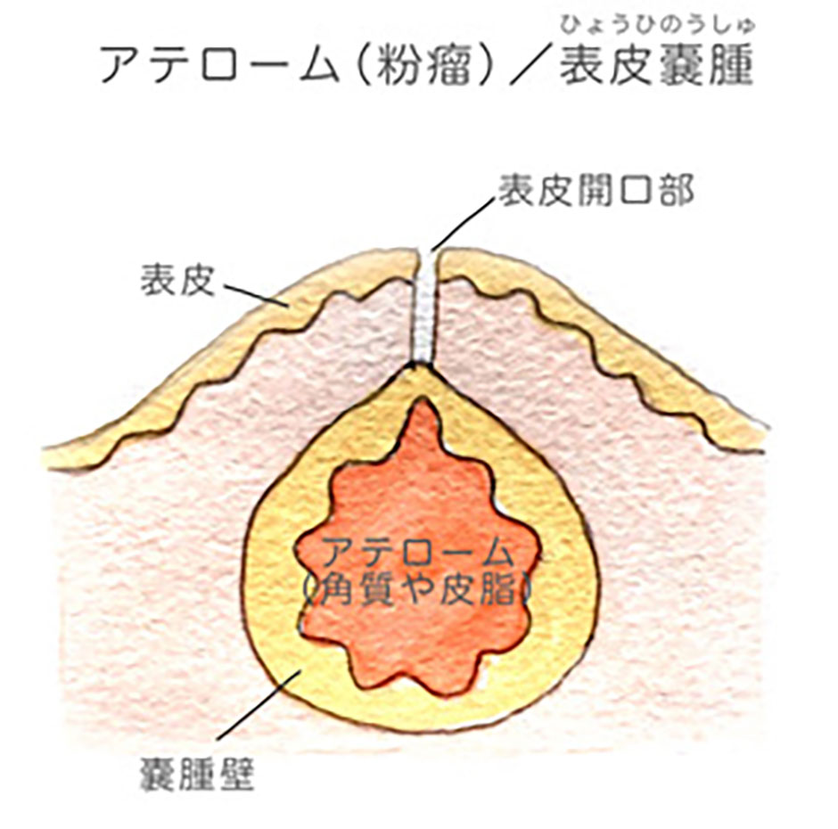 粉瘤（アテローマ）