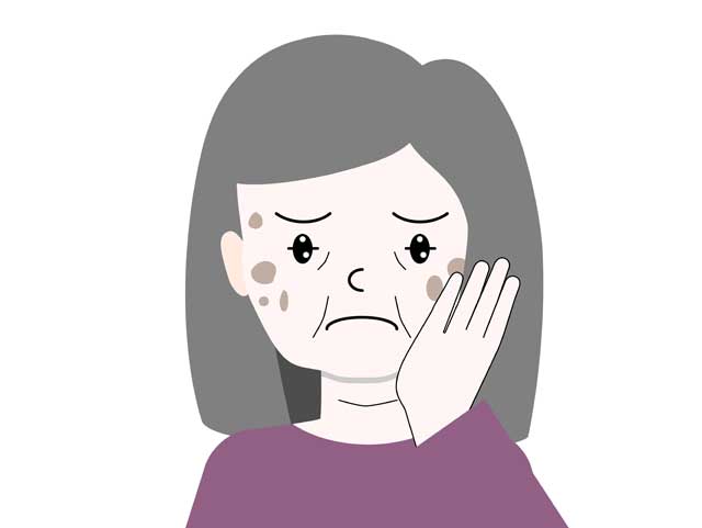 光線角化症・・・皮膚の悪性腫瘍