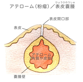 粉瘤（アテローマ・アテローム） 表皮嚢腫
