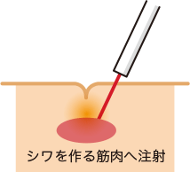 シワを作る筋肉へ注射