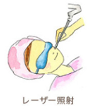 レーザー照射