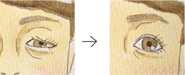 上まぶたのたるみとり