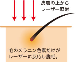 皮膚の上からレーザー照射 毛のメラニン色素だけがレーザーに反応し脱毛。