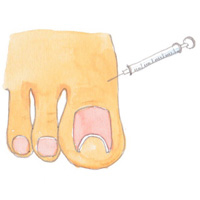 1. 指の付け根近くに麻酔の注射をします。5分くらいすると指の先端まで麻酔が行き渡ります。
