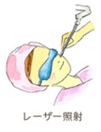 レーザー照射
