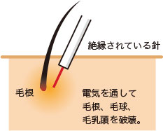 電気を通して毛根、毛球、毛乳頭を破壊。